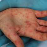 Los casos de sarampión se duplicaron en el país en una semana, según el Ministerio de Salud.(Foto Prensa Libre: Hemeroteca PL)