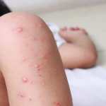 Guatemala registra 175 casos de sarampión al 5 de febrero de 2026. De acuerdo con el Ministerio de Salud, las bajas coberturas de vacunación, alta movilidad y múltiples puntos de entrada explican su impacto regional. (Foto, Prensa Libre: ShutterStock)