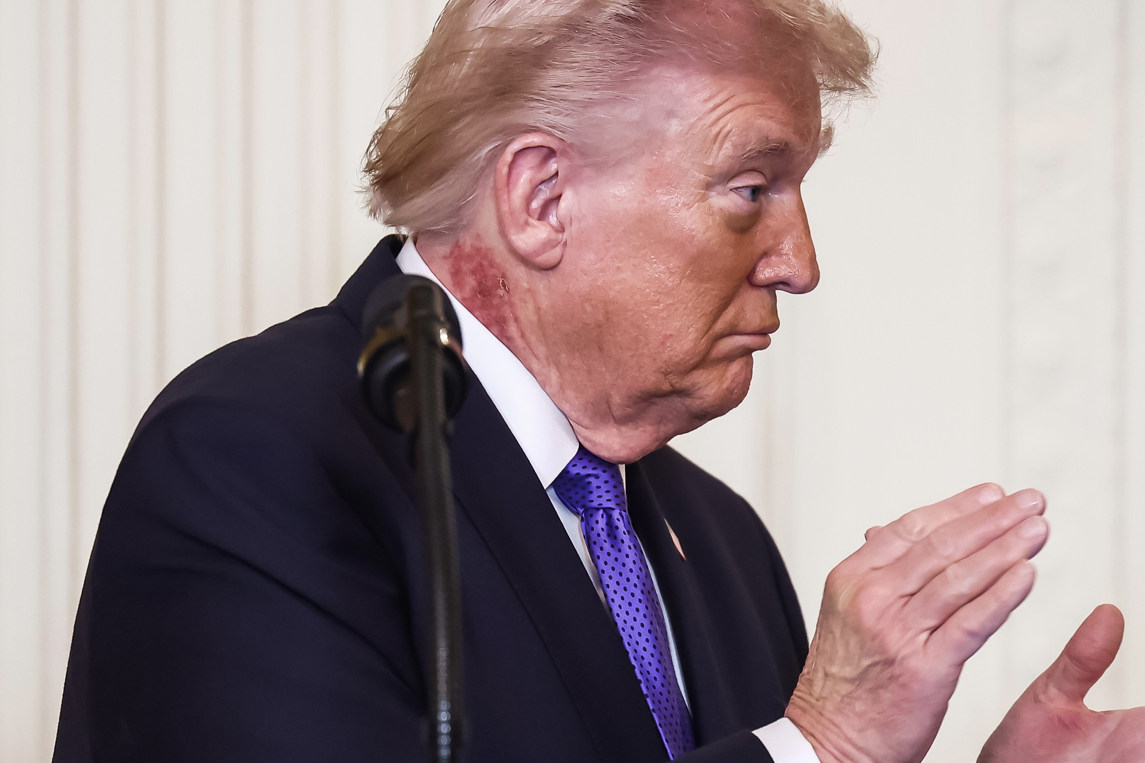 WASHINGTON (United States), 02/03/2026.- US President Donald Trump attends a medal of honor ceremony in the East Room of the White House in Washington, DC, USA, 02 March 2026. The President has a red rash on the right side of his neck. EFE/EPA/JIM LO SCALZO / POOL