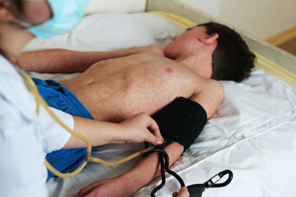 Autoridades de salud recuerdan que la vacuna contra el sarampión es gratuita, se aplica desde los 6 meses y está disponible incluso durante Semana Santa en centros habilitados. (Foto, Prensa Libre: ShutterStock)