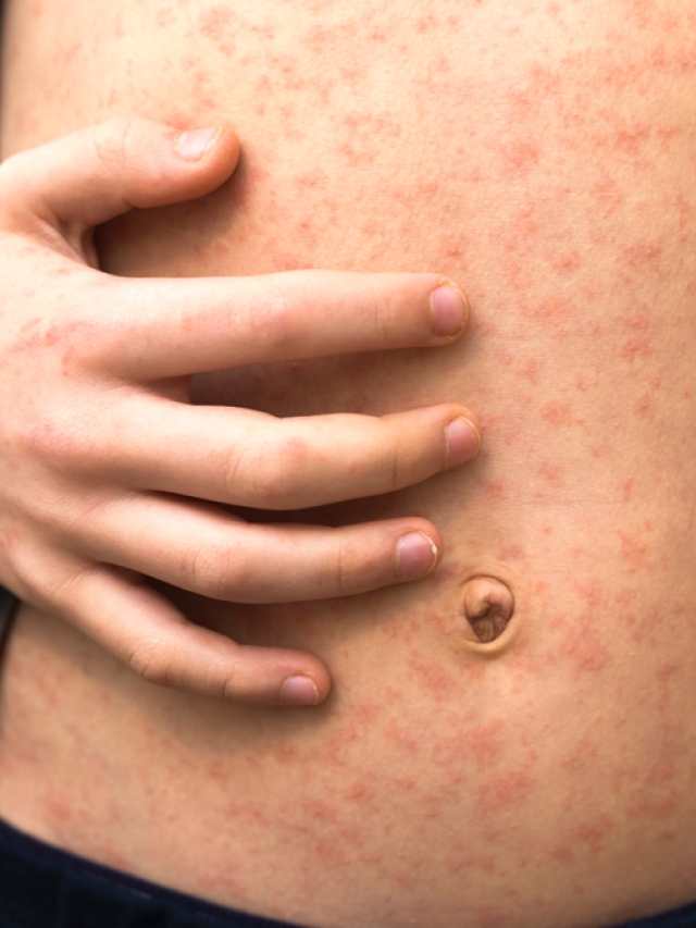 Sarampión: cómo puede borrar hasta el 73% de los anticuerpos en niños