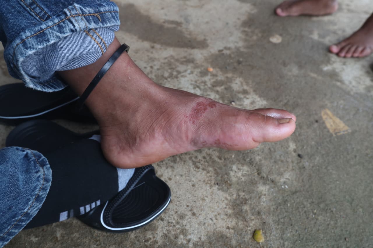 Las infecciones en la piel comenzaron a afectar a niños refugiados en los albergues habilitados en Fray Bartolomé de las Casas después del desbordamiento del río Sepur. (Foto Prensa Libre: Moisés Xec) 