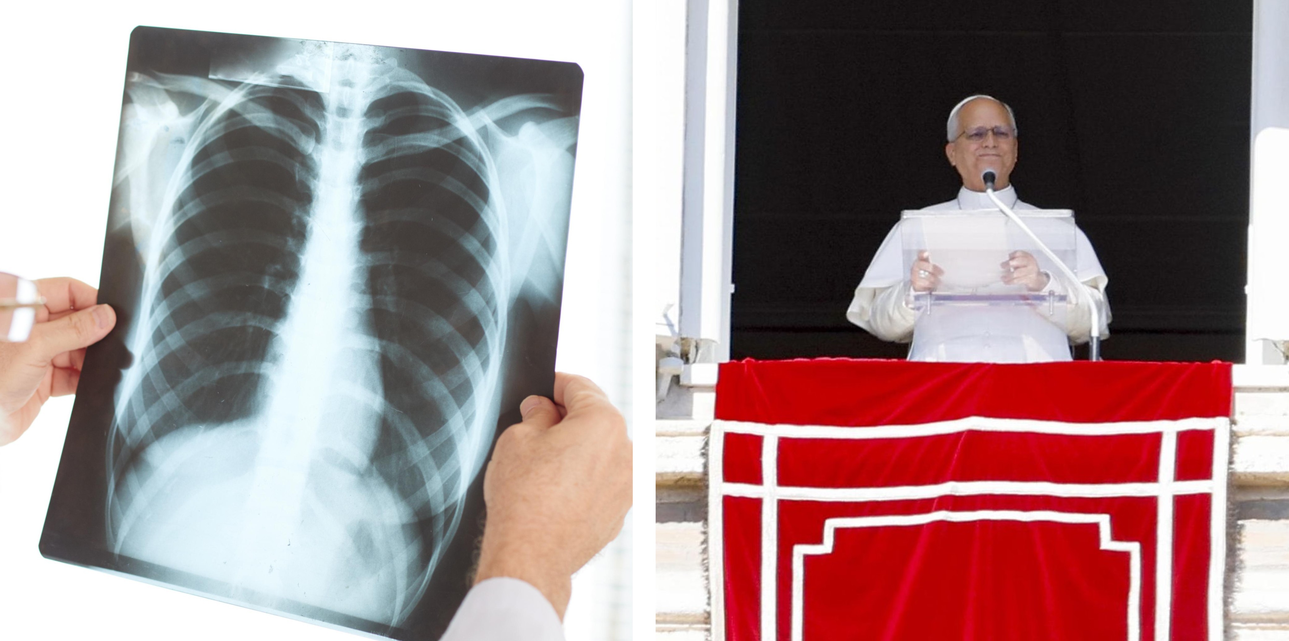 La operación a la que se someterá el papa León XIV, cómo se extirpa un nódulo pulmonar